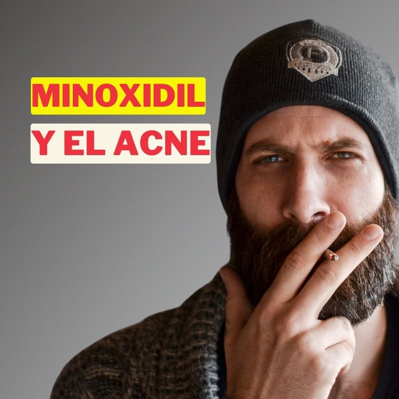 Minoxidil y el acné: ¿Existe relación? Descubre la verdad