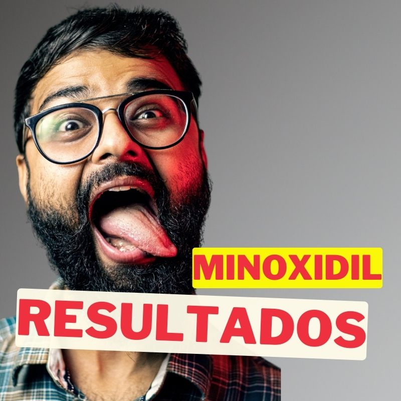 Minoxidil para el Crecimiento de la Barba y el Bigote: Resultados, Efectividad y Tiempo de Espera