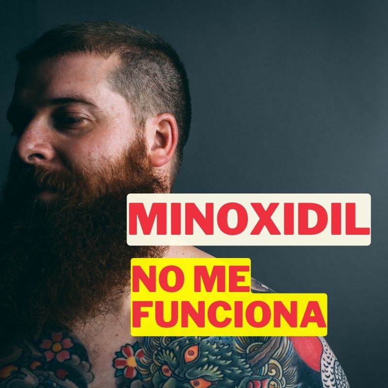 ¿Por qué el minoxidil no me funciona? Descubre las razones aquí