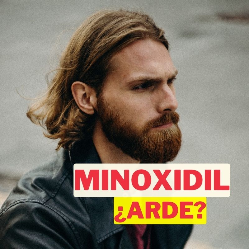 ¿Por qué arde el minoxidil? Descubre la razón aquí