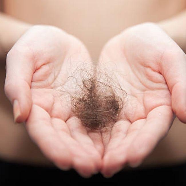 ¿Qué es la alopecia frontal fibrosante y cómo tratarla?