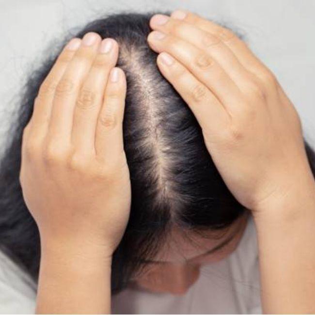 ¿Sabes qué es la alopecia androgenética de las mujeres?